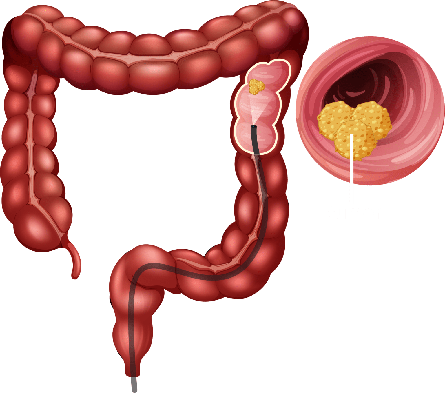 colon-cancer-trials-of-color